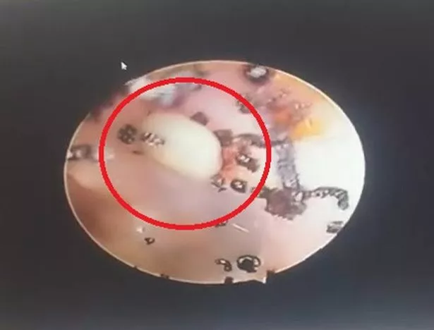 孩子抱怨耳朵疼痛，医生惊讶地发现了“数百个”虱子